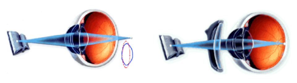 PRESBIOPIA ( LENTI COMPRESE NEL PREZZO FINO A SF +4 E CYL 4 ) PRESBIOPIA ( LENTI COMPRESE NEL PREZZO FINO A SF +4 E CYL 4 )