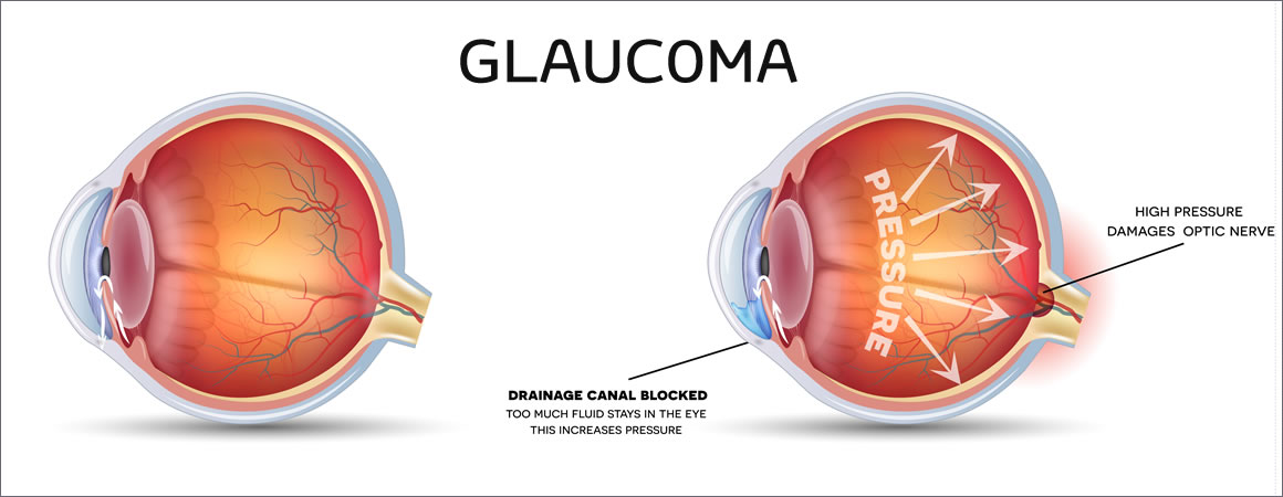 Il glaucoma Il glaucoma