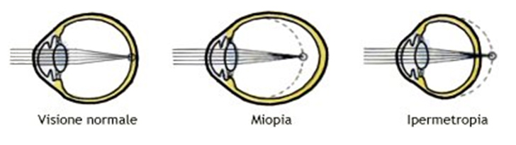 I DIFETTI OTTICI DELL'OCCHIO I DIFETTI OTTICI DELL'OCCHIO