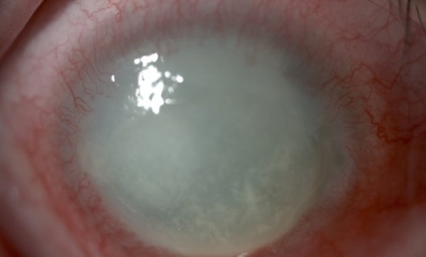 Cheratite da acanthamoeba di cosa si tratta?