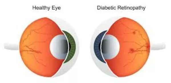 RETINOPATIA DIABETICA RETINOPATIA DIABETICA