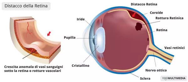 Distacco della retina: cause, sintomi e prevenzione  Distacco della retina: cause, sintomi e prevenzione