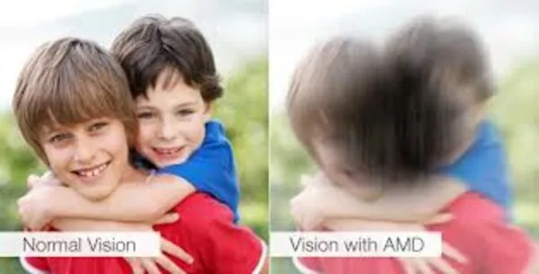 Degenerazione maculare legata all’età: conoscerla e distinguerla da altre patologie visive  Degenerazione maculare legata all’età: conoscerla e distinguerla da altre patologie visive