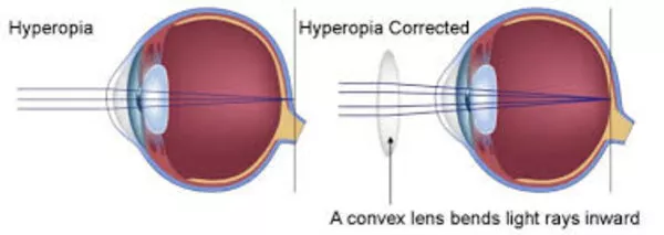 Ipermetropia: un difetto visivo comune da non sottovalutare  Ipermetropia: un difetto visivo comune da non sottovalutare